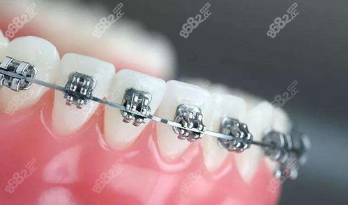 肇庆正畸牙科名单与费用指南 专业选择，美丽启航